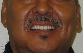 Implant Over Denture After