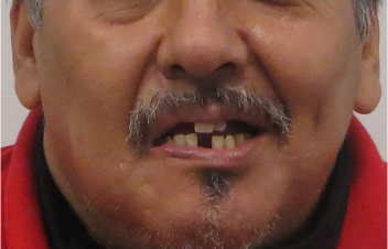 Implant Over Denture Before